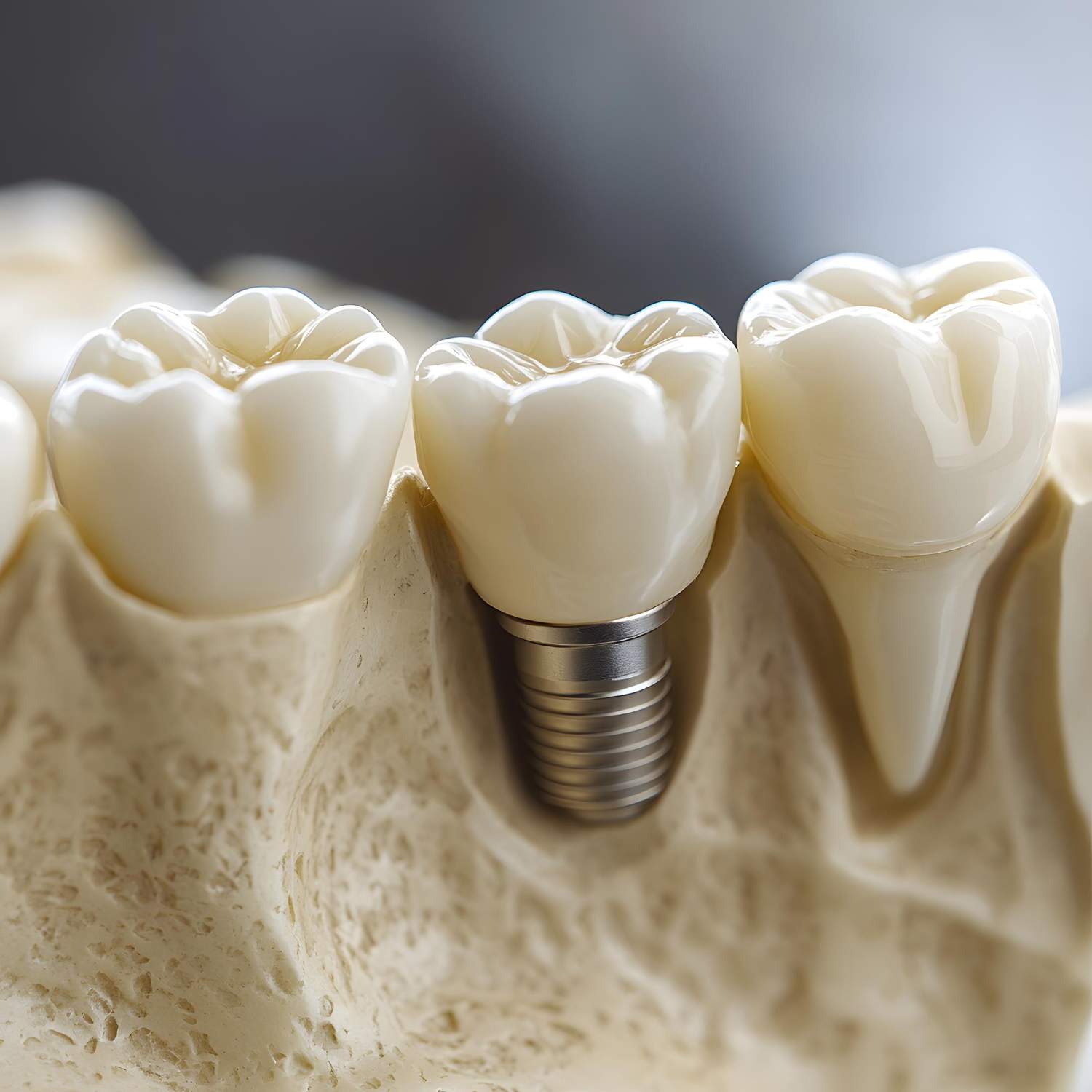 Implantes dentales con opciones de financiación para tu tratamiento en Ciudad Universitaria